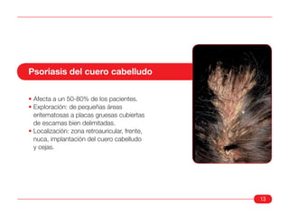 Psoriasis del cuero cabelludo

• Afecta a un 50-80% de los pacientes.
• Exploración: de pequeñas áreas
  eritematosas a placas gruesas cubiertas
  de escamas bien delimitadas.
• Localización: zona retroauricular, frente,
  nuca, implantación del cuero cabelludo
  y cejas.




                                               13
 