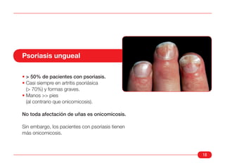 Psoriasis ungueal

• > 50% de pacientes con psoriasis.
• Casi siempre en artritis psoriásica
  (> 70%) y formas graves.
• Manos >> pies
  (al contrario que onicomicosis).

No toda afectación de uñas es onicomicosis.

Sin embargo, los pacientes con psoriasis tienen
más onicomicosis.



                                                  18
 