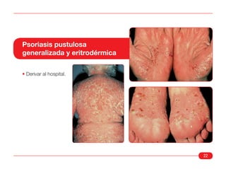 Psoriasis pustulosa
generalizada y eritrodérmica

• Derivar al hospital.




                               22
 