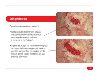 Diagnóstico

Característico en la exploración:

• Después de desprender capas
  sucesivas de escamas aparece
  una membrana lisa brillante
  (membrana de Bulkley).

• Signo de Auspitz o rocío hemorrágico:
  al raspar la lesión surgen pequeños
  puntos sangrantes causados por la
  lesión de los vasos dilatados en las
  papilas dérmicas.




                                          6
 