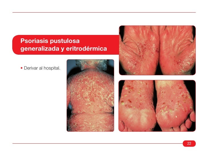 La psoriasis triderm las revocaciones