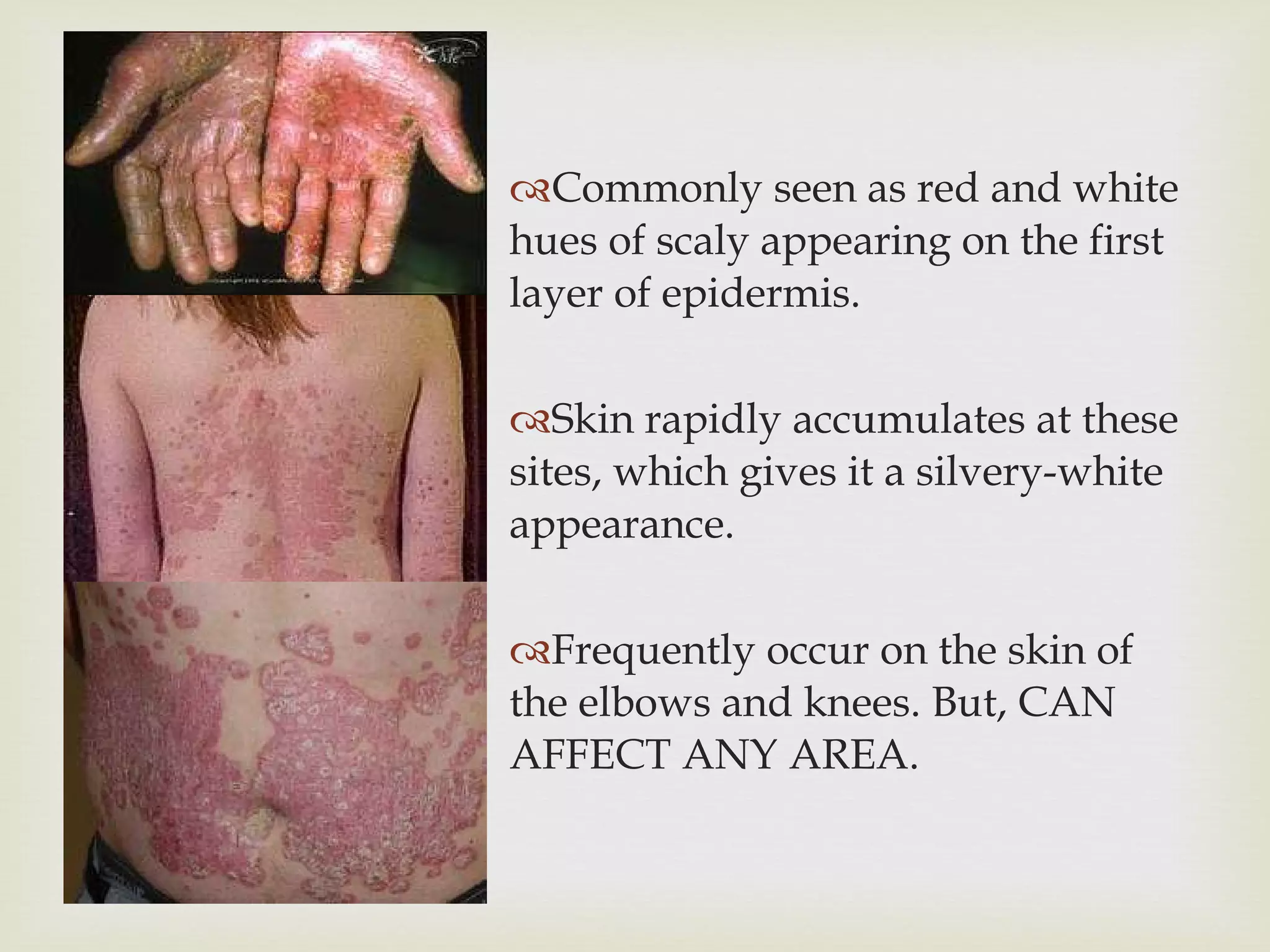 Psoriasis | PPT
