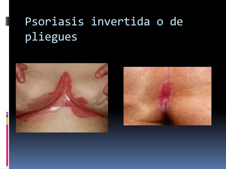 Atopichesky la dermatitis de la complicación de la foto