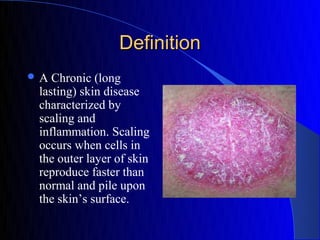 Definition
A  Chronic (long
 lasting) skin disease
 characterized by
 scaling and
 inflammation. Scaling
 occurs when cells in
 the outer layer of skin
 reproduce faster than
 normal and pile upon
 the skin’s surface.
 