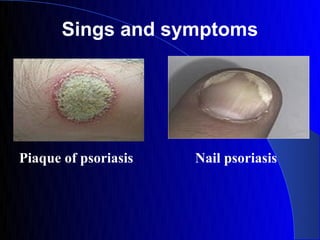 Sings and symptoms




Piaque of psoriasis   Nail psoriasis
 