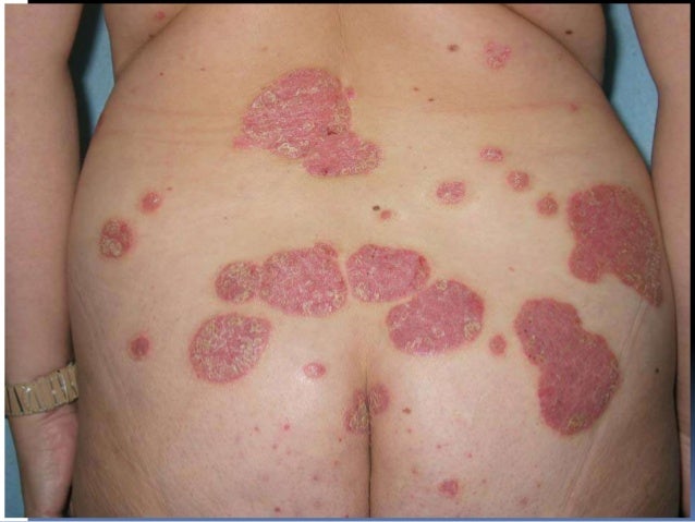 La psoriasis el tratamiento por el sáuco rojo