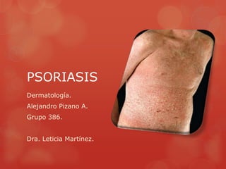 PSORIASIS
Dermatología.
Alejandro Pizano A.
Grupo 386.


Dra. Leticia Martínez.
 