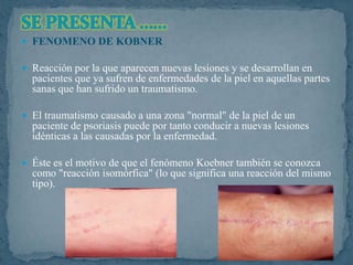  FENOMENO DE KOBNER
 Reacción por la que aparecen nuevas lesiones y se desarrollan en
pacientes que ya sufren de enfermedades de la piel en aquellas partes
sanas que han sufrido un traumatismo.
 El traumatismo causado a una zona "normal" de la piel de un
paciente de psoriasis puede por tanto conducir a nuevas lesiones
idénticas a las causadas por la enfermedad.
 Éste es el motivo de que el fenómeno Koebner también se conozca
como "reacción isomórfica" (lo que significa una reacción del mismo
tipo).
 
