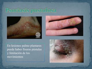 En lesiones palmo plantares
puede haber fisuras pústulas
y limitación de los
movimientos
 