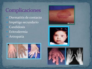  Dermatitis de contacto
 Impétigo secundario
 Candidosis
 Eritrodermia
 Artropatía
 