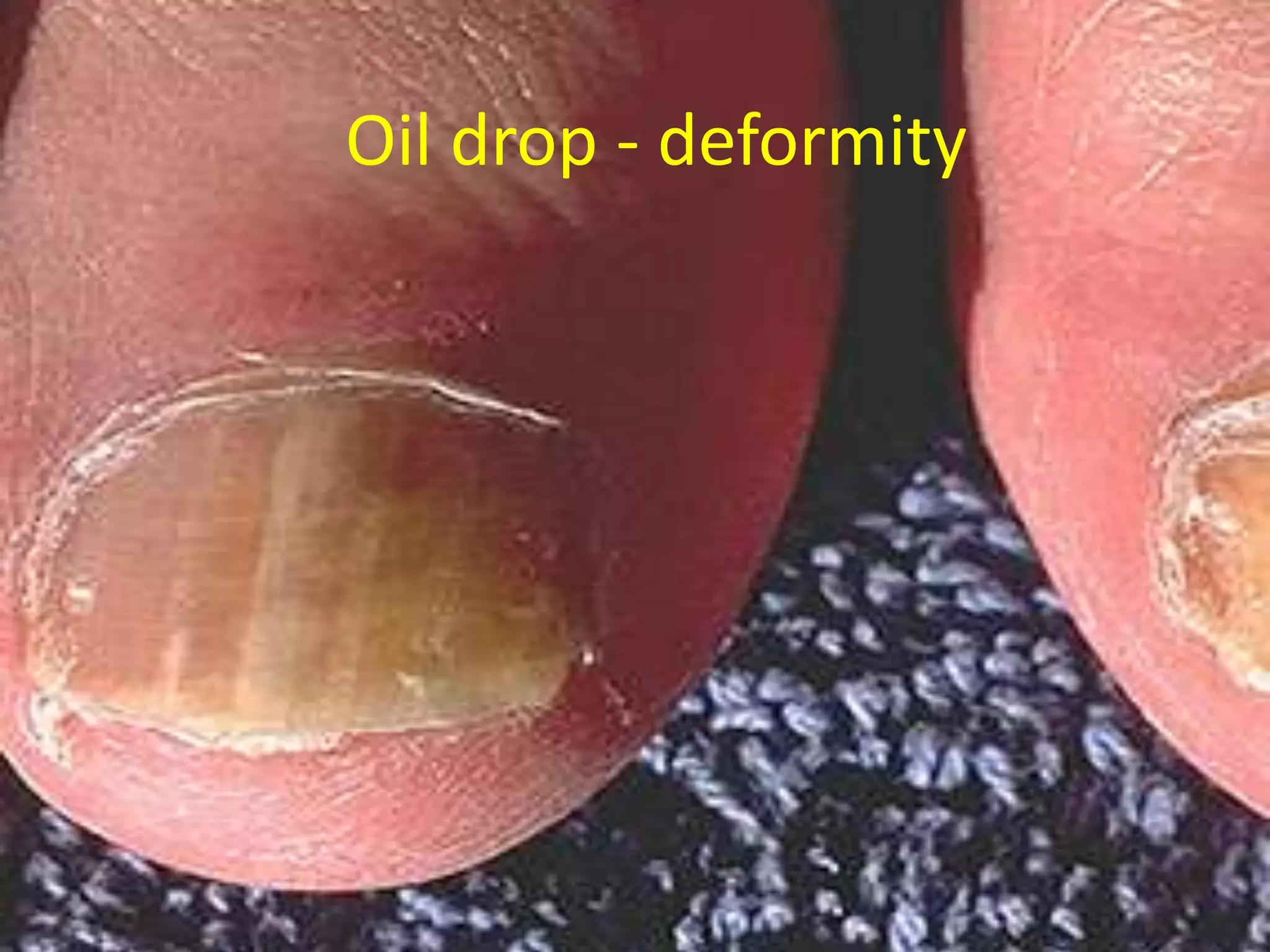 Oil drop - deformity

 