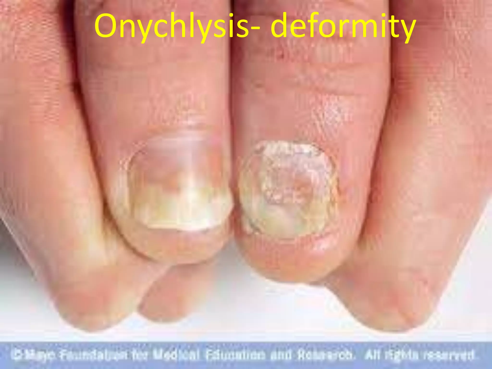 Onychlysis- deformity

 