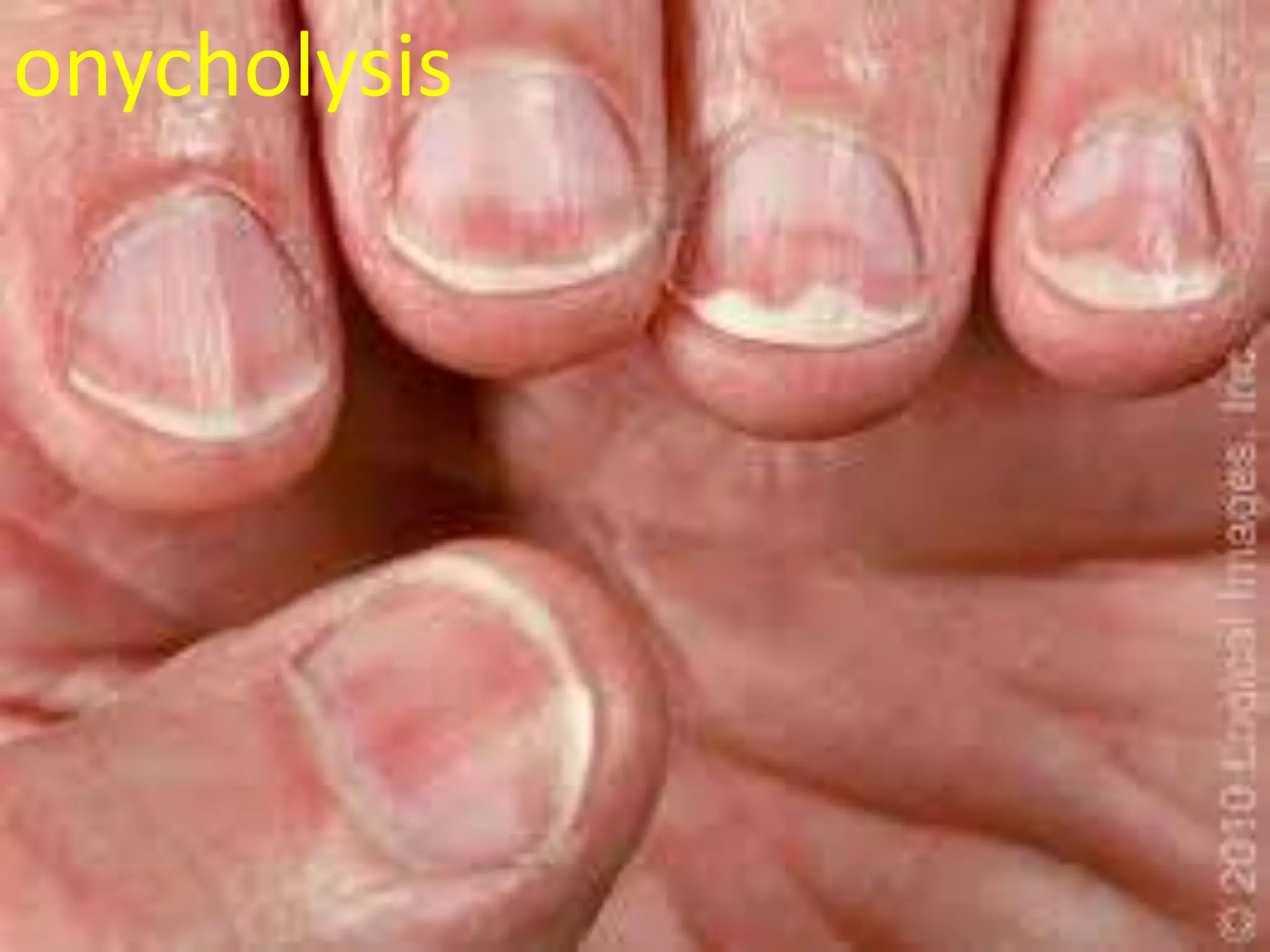 onycholysis

 