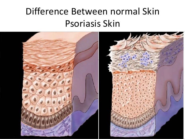 psoriatic lesions #11