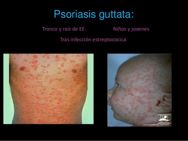 El tratamiento de la eccema por la grasa de ganso
