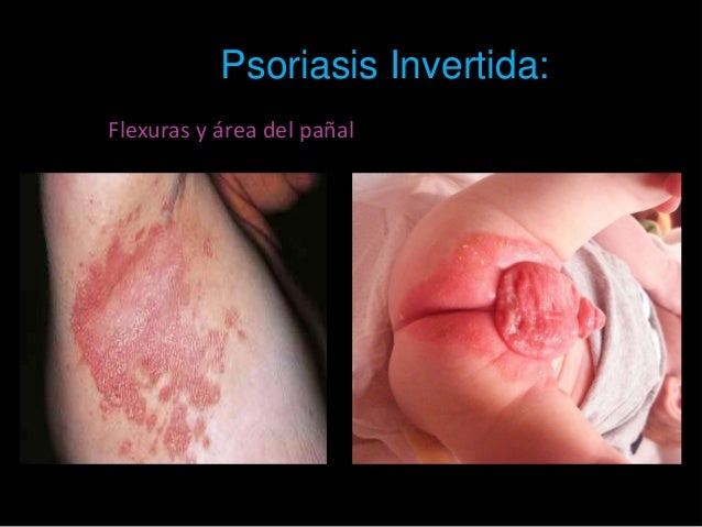 El tratamiento de la psoriasis en las canoas