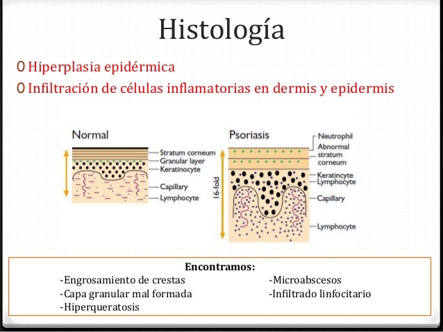 Los ungüentos con la celidonia mayor a la psoriasis