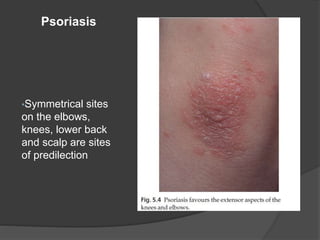 •Symmetrical sites
on the elbows,
knees, lower back
and scalp are sites
of predilection
Psoriasis
 