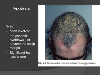 Psoriasis
Scalp
• often involved
• the psoriasis
overflows just
beyond the scalp
margin
• Significant hair
loss is rare
 