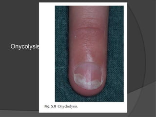 Onycolysis
 