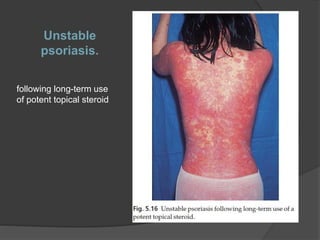 Unstable
psoriasis.
following long-term use
of potent topical steroid
 