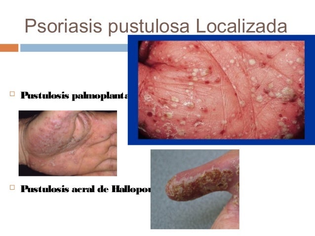 La psoriasis los indicios y como curar