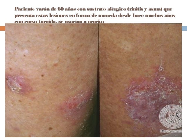 Que tratamiento fijan a la psoriasis