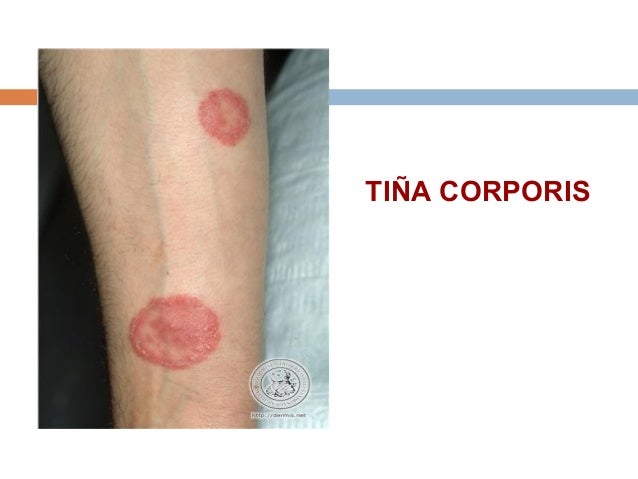 La agua oxigenada para el tratamiento de la psoriasis