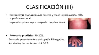CLASIFICACIÓN (III)
• Eritrodermia psoriásica: más eritema y menos descamación, 90%
superficie corporal.
Ingreso hospitalario por riesgo de complicaciones.
• Artropatía psoriásica: 10-20%.
Se asocia generalmente a onicopatía. FR negativo.
Asociación frecuente con HLA B-27.
 