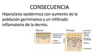 CONSECUENCIA
Hiperplasia epidérmica con aumento de la
población germinativa y un infiltrado
inflamatorio de la dermis.
 