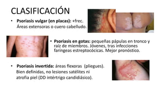 CLASIFICACIÓN
• Psoriasis vulgar (en placas): +frec.
Áreas extensoras o cuero cabelludo.
• Psoriasis en gotas: pequeñas pápulas en tronco y
raíz de miembros. Jóvenes, tras infecciones
faríngeas estreptocócicas. Mejor pronóstico.
• Psoriasis invertida: áreas flexoras (pliegues).
Bien definidas, no lesiones satélites ni
atrofia piel (DD intértrigo candidiásico).
 