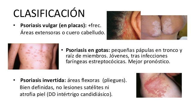 Si no influye la psoriasis sobre el embarazo