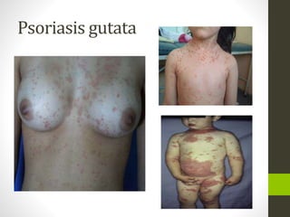 Psoriasis gutata
 
