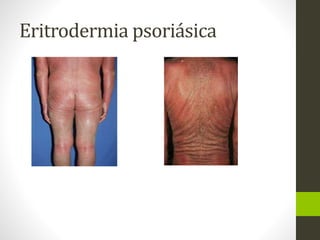 Eritrodermia psoriásica
 