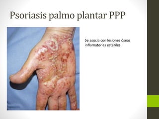 Psoriasis palmo plantar PPP
Se asocia con lesiones óseas
inflamatorias estériles.
 