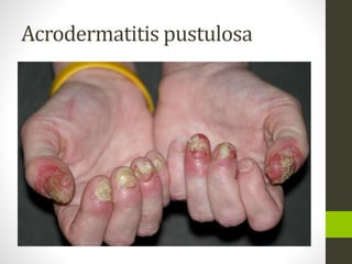 Acrodermatitis pustulosa
 