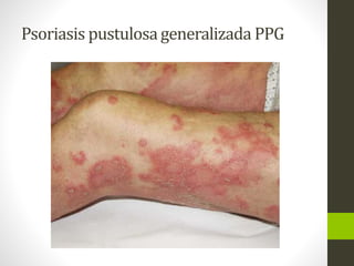 Psoriasis pustulosa generalizada PPG
 