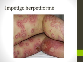 Impétigo herpetiforme
 