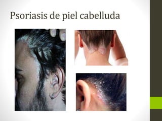 Psoriasis de piel cabelluda
 