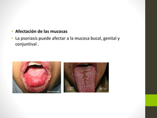 • Afectación de las mucosas
• La psoriasis puede afectar a la mucosa bucal, genital y
conjuntival .
 