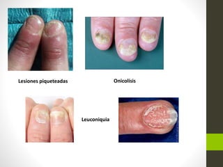 Lesiones piqueteadas Onicolisis
Leuconiquia
 