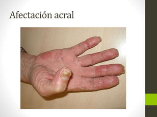 Afectación acral
 