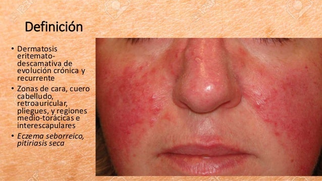 Curar la psoriasis sobre la nariz
