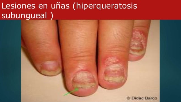 Seboreya o la psoriasis como distinguir la foto