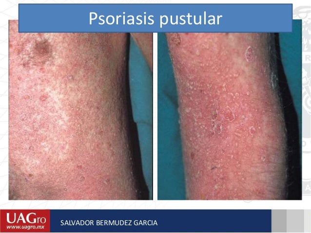 El tratamiento de la psoriasis por la medicina asd 2