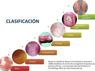 Placa
Inversa
Eritrodermica
Pustular
Guttata
Psoriasis en
uñas
Artritis
psoriatica
Menter A, Gottlieb A, Steven R, Van Vorhees S, Leonardi C.
(2008) 'Guidelines of care for the management of psoriasis and
psoriatic arthritis.', Journal of the American Academy of
Dermatology, 58(5), pp. http://www.jaad.org
CLASIFICACIÓN
 