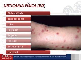 Piel cabelluda
Zona del pañal
Uñas
Pustulosa
En gotas
Folicular
Eritrodermica
Universal
URTICARIA FÍSICA (ED)
Arenas R (2015) Dermatología. Atlas, diagnóstico y tratamiento., 6ta edn., México: McGrawHill.
 