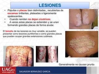 • Pápulas o placas bien delimitadas,, recubiertas de
escamas brillantes, plateadas o ligeramente
opalescentes.
• Cuando remiten no dejan cicatrices;
• A veces estas placas se extienden y se unen
formando grandes placas de forma anular.
LESIONES
Generalmente no causan prurito
El tamaño de las lesiones es muy variable, se pueden
presentar como lesiones purtiformes o como grandes placas
que pueden ocupar grandes extensiones cutáneas.
SALVADOR BERMUDEZ GARCIA
 