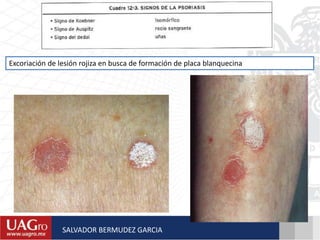 Excoriación de lesión rojiza en busca de formación de placa blanquecina
SALVADOR BERMUDEZ GARCIA
 