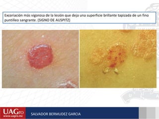 Excoriación más vigorosa de la lesión que deja una superficie brillante tapizada de un fino
puntilleo sangrante. (SIGNO DE AUSPITZ)
SALVADOR BERMUDEZ GARCIA
 